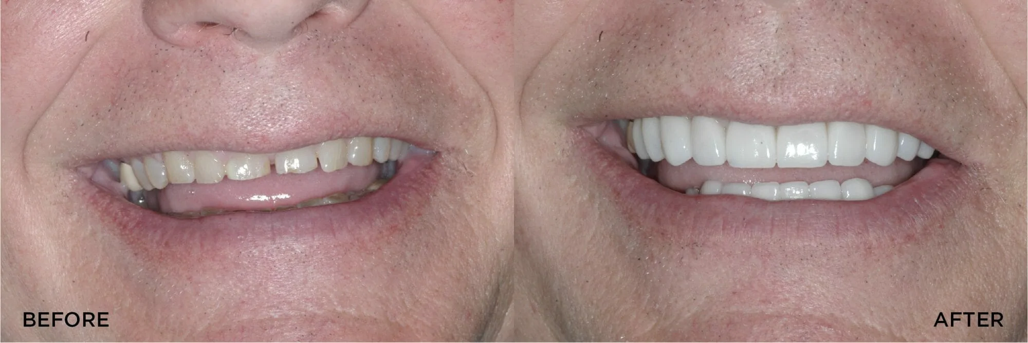 Full Mouth Rehab with Crowns Veneers"