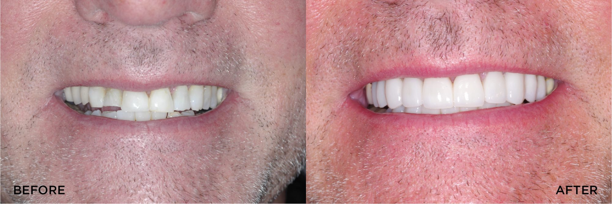 Full Mouth Rehab with Crowns Veneers